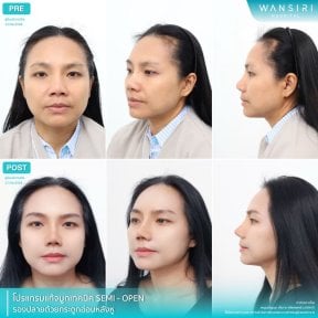 before-after photo rhinoplasty-nose-job