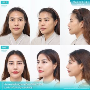 before-after photo rhinoplasty-nose-job