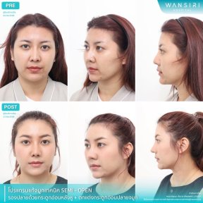before-after photo rhinoplasty-nose-job