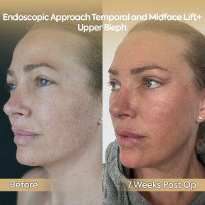 before-after photo neck-lift