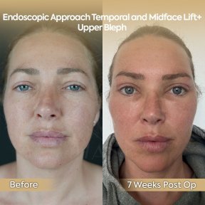 before-after photo neck-lift