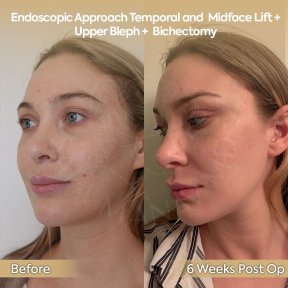 before-after photo neck-lift