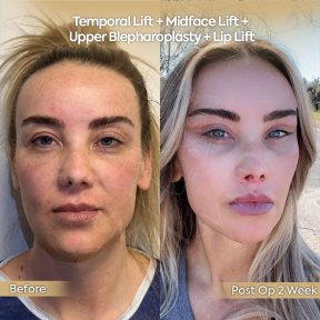 before-after photo neck-lift