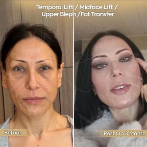 before-after photo neck-lift