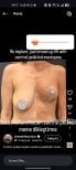 Before and after breast lift without implants at Turan Turan Health Group, mastopexy results