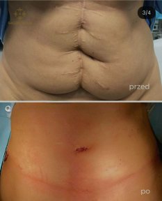 Before and after tummy tuck and liposuction results at Radzikowska Clinic, flatter abdomen