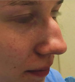 Avant la rhinoplastie à la Radzikowska Clinic, forme du nez avant le résultat
