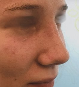 Résultat de rhinoplastie à la Radzikowska Clinic, amélioration naturelle du nez