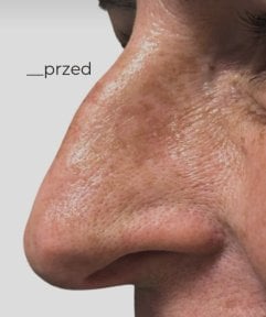 Avant rhinoplastie à la Radzikowska Clinic, forme du nez avant chirurgie