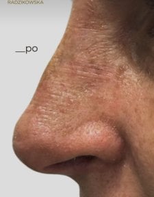 Résultat de rhinoplastie à la Radzikowska Clinic – forme du nez améliorée après chirurgie