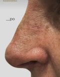 Résultat de rhinoplastie à la Radzikowska Clinic – forme du nez améliorée après chirurgie