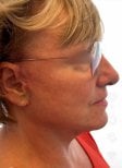 Deep Plane Facelift Ergebnis in der Radzikowska Clinic – glattere Kinnlinie, jüngeres Gesicht