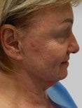 Vor Deep Plane Facelift in der Radzikowska Clinic, sichtbare Hauterschlaffung und Falten