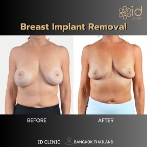 Результаты до и после удаления грудных имплантов в ID Clinic Bangkok, естественный контур