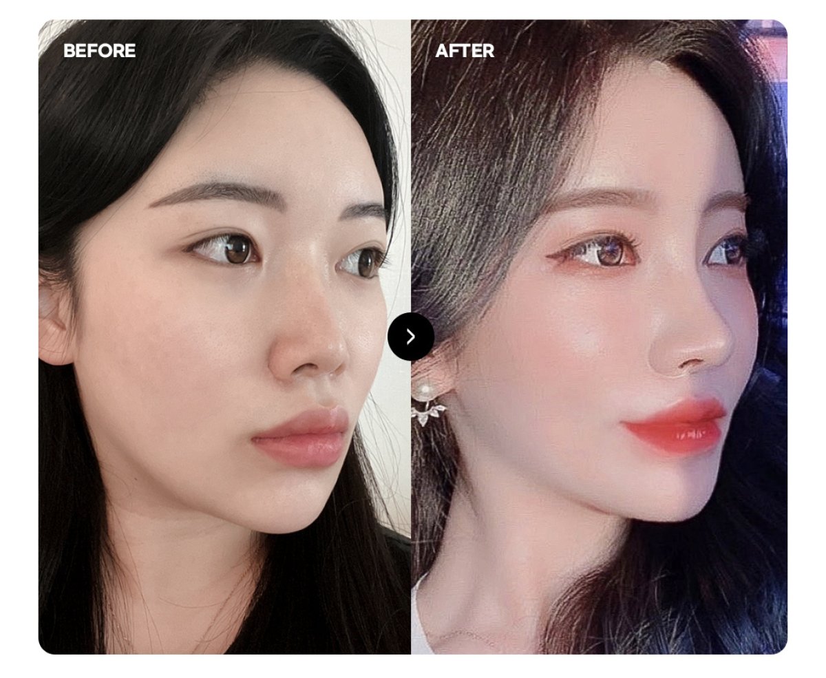 Resultados de transferencia de grasa facial antes y después: mejillas y mandíbula realzadas