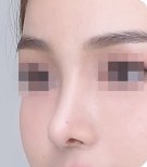 نتيجة عملية تجميل الأنف، شكل أنف مصقول بمظهر طبيعي بعد الجراحة