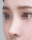 نتيجة عملية تجميل الأنف، شكل أنف مصقول بعد الجراحة