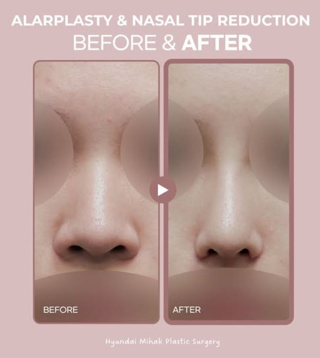 Resultados antes y después de alarplastia y reducción de punta nasal en Hyundai Mihak Plastic Surgery