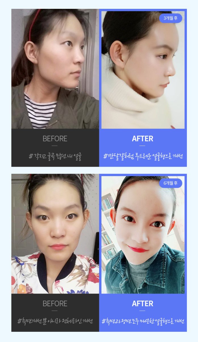 Resultados antes y después de reducción de pómulos – mejora visible del contorno facial