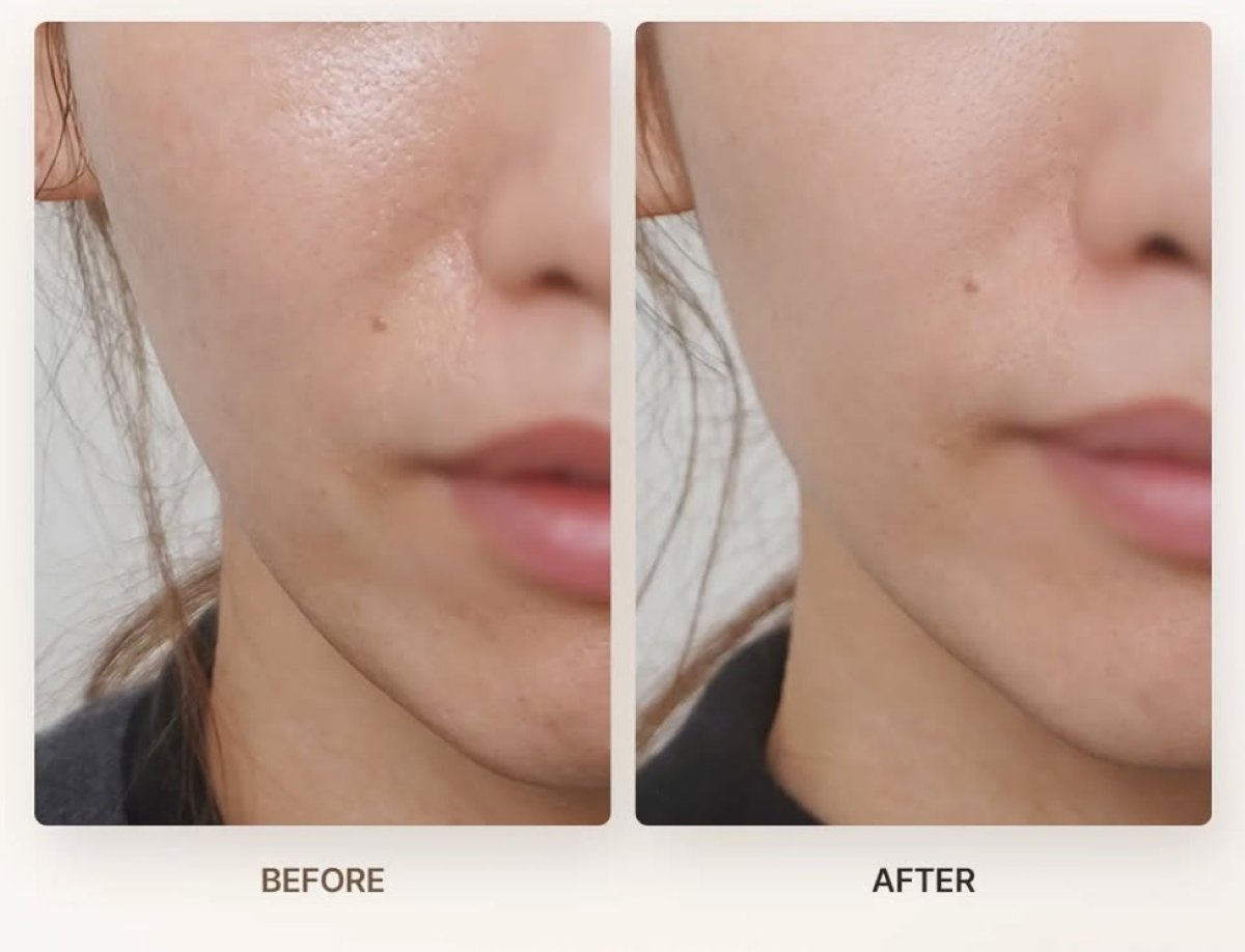 Resultados de Thermage en rostro antes y después: piel más firme y suave