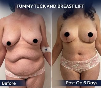 before-after photo mastopexy-breast-lift-contour-plastics