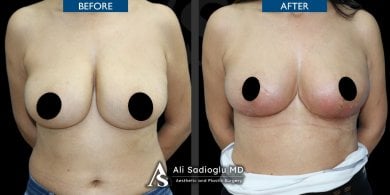 before-after photo mastopexy-breast-lift-contour-plastics