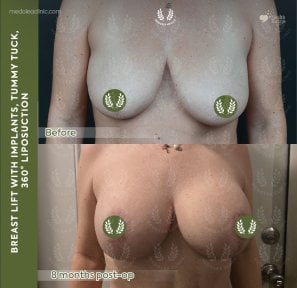 before-after photo mastopexy-breast-lift-contour-plastics