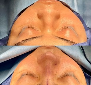 before-after photo rhinoplasty-nose-job