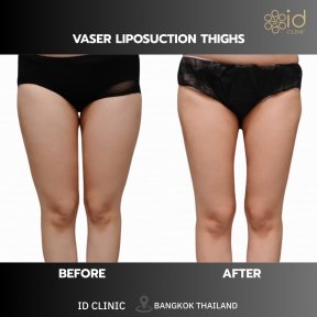 before-after photo liposakciya