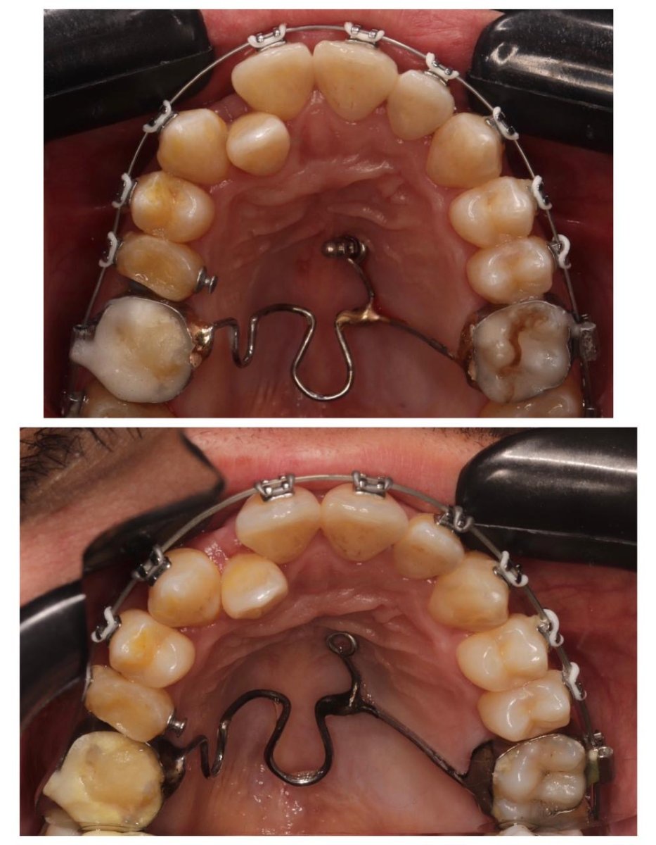 Resultados antes y después de brackets: mejora de alineación dental superior con ortodoncia