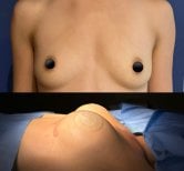 Résultats avant et après augmentation mammaire chez Lucio Santos Plastic Surgery, volume accru