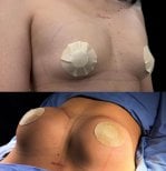 Résultats avant et après augmentation mammaire chez Lucio Santos Plastic Surgery, volume accru
