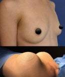 Avant et après augmentation mammaire chez Lucio Santos Plastic Surgery, résultat volume accru