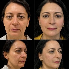 Résultats avant et après blépharoplastie chez Lucio Santos Plastic Surgery, correction des paupières