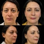 Résultats avant et après blépharoplastie chez Lucio Santos Plastic Surgery, correction des paupières
