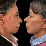 Résultats avant et après blépharoplastie chez Lucio Santos Plastic Surgery, correction des paupières