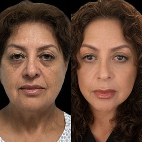 Résultats avant et après blépharoplastie chez Lucio Santos Plastic Surgery, correction des paupières