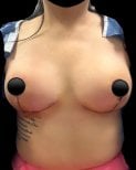Résultat de réduction mammaire chez Lucio Santos Plastic Surgery avec contour amélioré