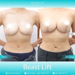 Before and after breast lift results at Wansiri Hospital, visible lift and contour improvement