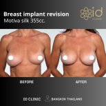 Résultats avant et après révision d’implants mammaires Motiva 355cc à ID Clinic Bangkok