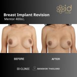 Résultats avant et après révision d’implants mammaires à ID Clinic Bangkok avec Mentor 400cc