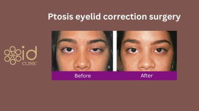 Before and after droopy eyelid surgery results at ID Clinic Bangkok, ptosis correction improvement