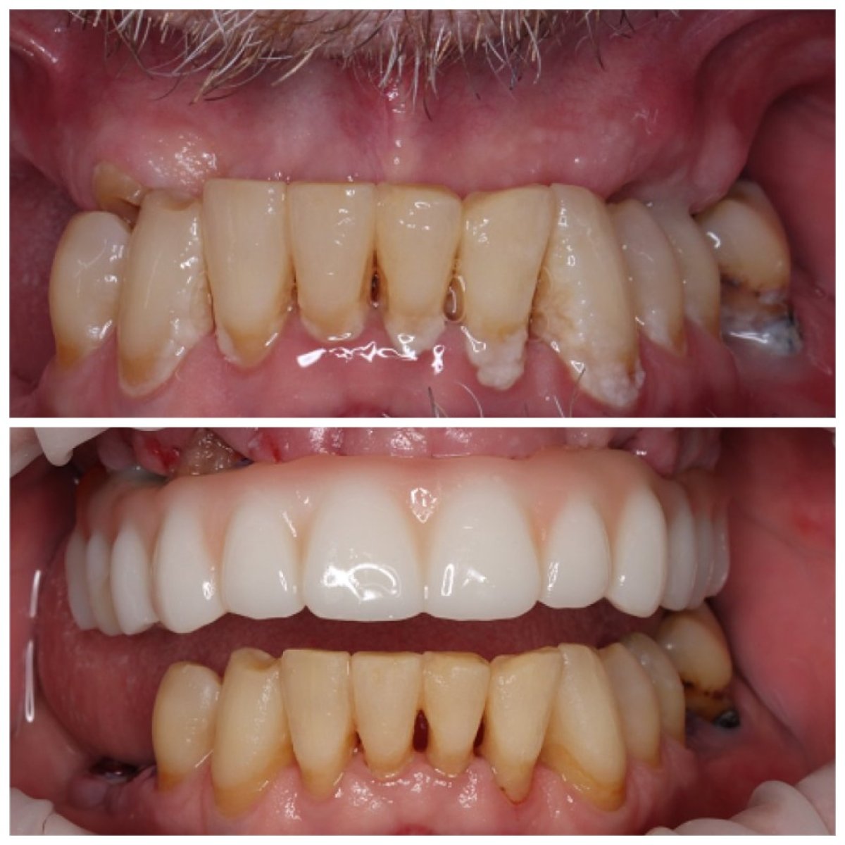 Resultados antes y después de implantes dentales: restauración de dientes superiores y sonrisa
