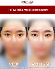 Результаты фокс-ай лифтинга и медиальной эпикантопластики в Returning Plastic Surgery через месяц
