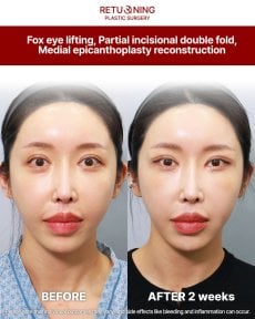Результаты до и после фокс ай лифтинга и блефаропластики в Returning Plastic Surgery