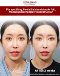 Результаты до и после фокс ай лифтинга и блефаропластики в Returning Plastic Surgery