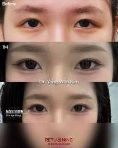 Блефаропластика до и после в Returning Plastic Surgery, результат коррекции век