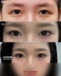 Блефаропластика до и после в Returning Plastic Surgery, результат коррекции век