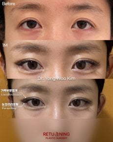 Результаты блефаропластики до и после в Returning Plastic Surgery, коррекция век