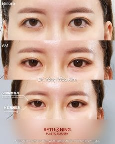 Блефаропластика до и после в Returning Plastic Surgery, результат коррекции век
